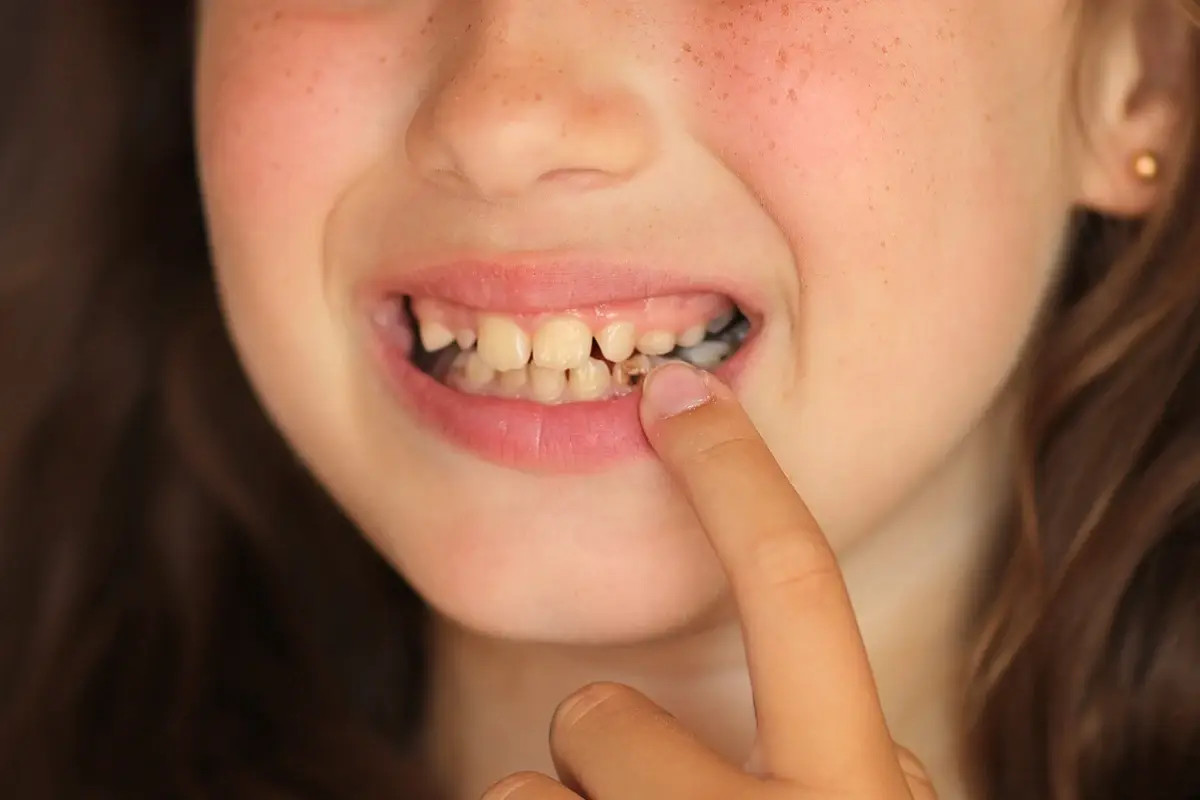 Child pointing to gap between front teeth showing cavity needs dental treatment.