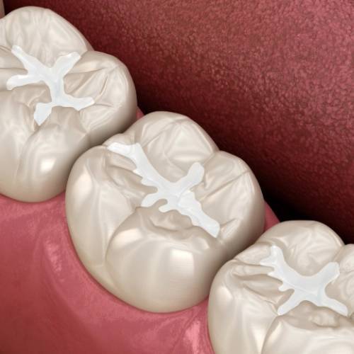 Dental sealants applied to child's molars to prevent cavities and tooth decay.